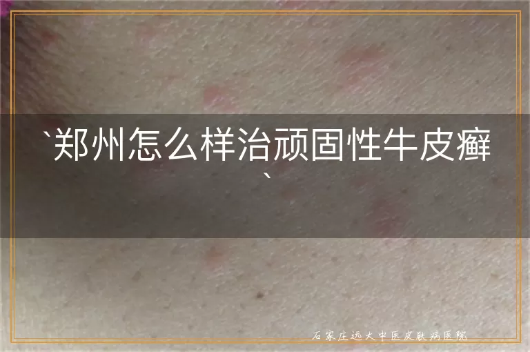 郑州怎么样治顽固性牛皮癣