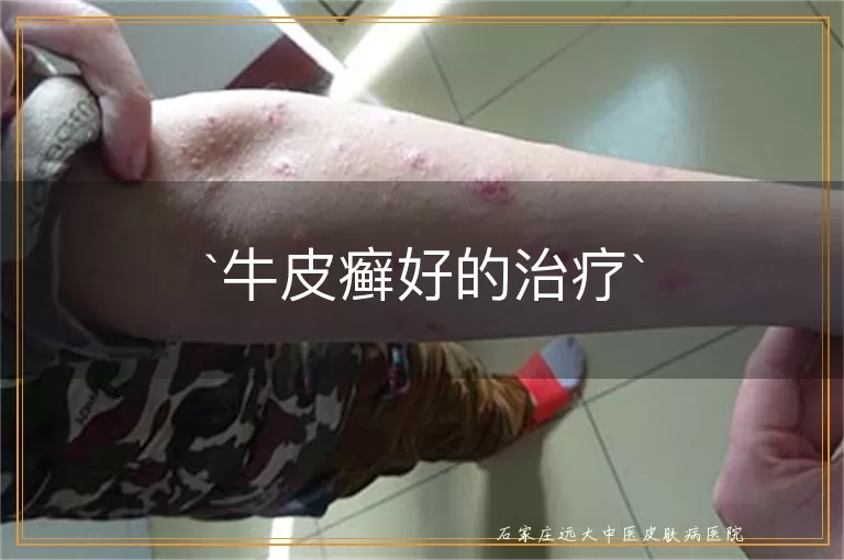 牛皮癣好的治疗