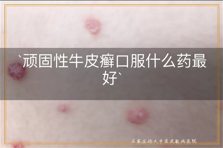 顽固性牛皮癣口服什么药最好