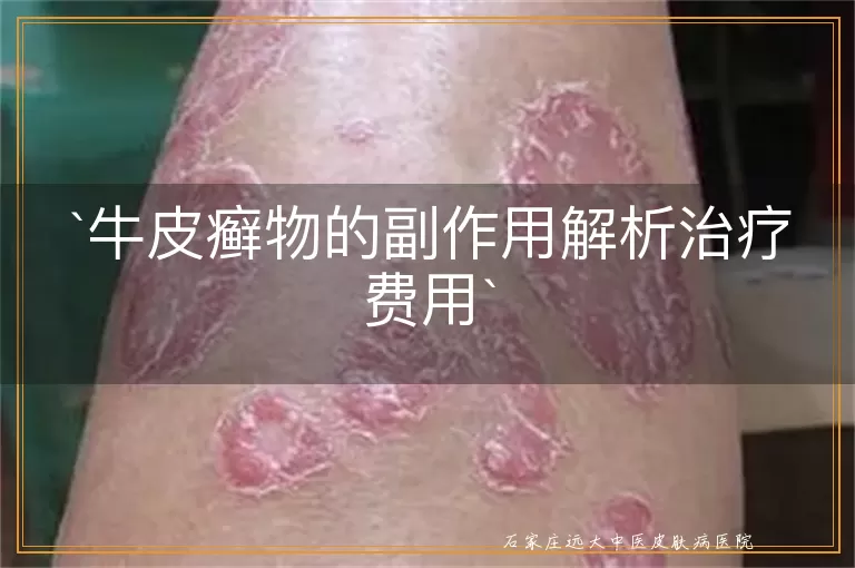 牛皮癣物的副作用解析治疗费用