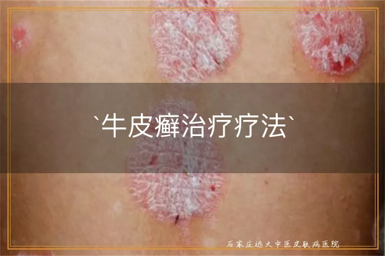 牛皮癣治疗疗法