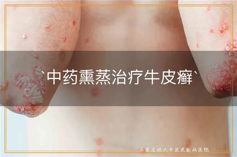 中药熏蒸治疗牛皮癣