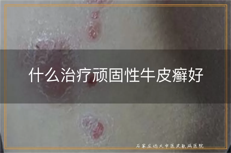 什么治疗顽固性牛皮癣好