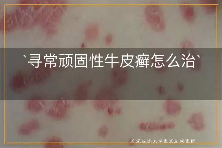 寻常顽固性牛皮癣怎么治