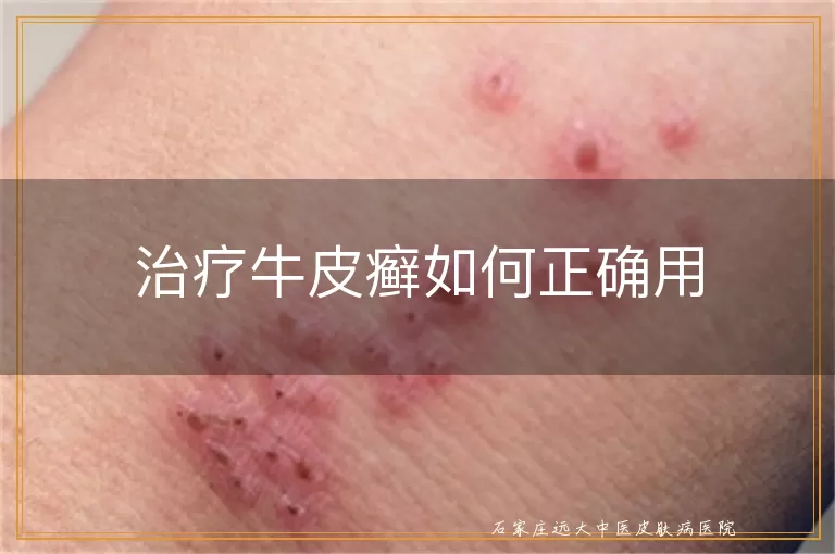 治疗牛皮癣如何正确用