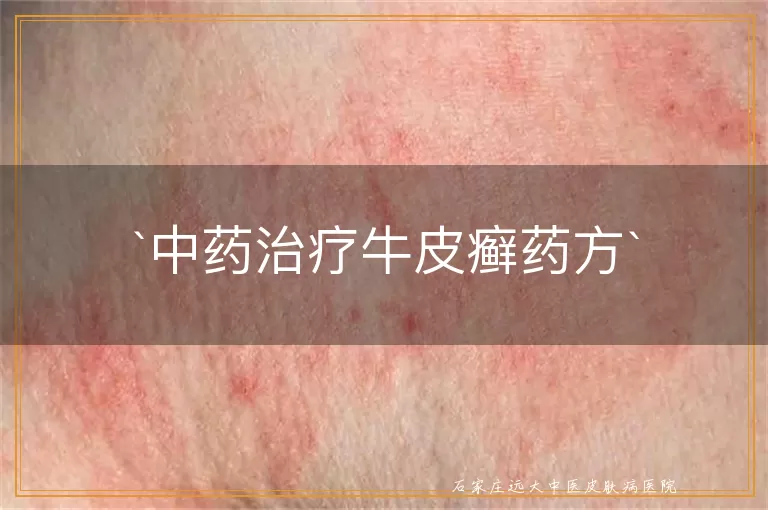 中药治疗牛皮癣药方