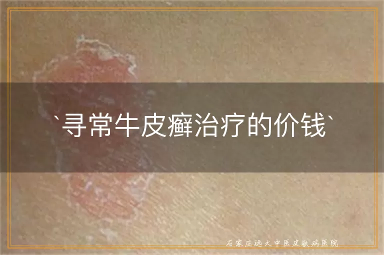 寻常牛皮癣治疗的价钱