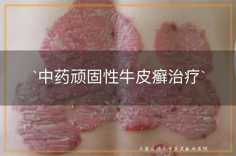 中药顽固性牛皮癣治疗