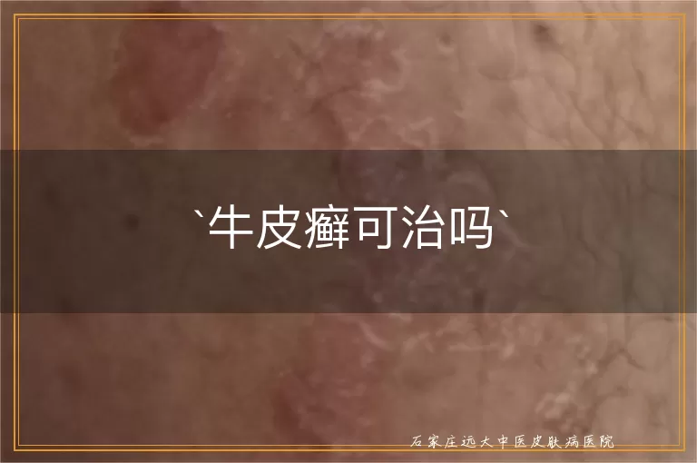 牛皮癣可治吗