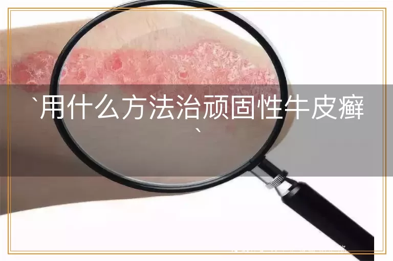 用什么方法治顽固性牛皮癣