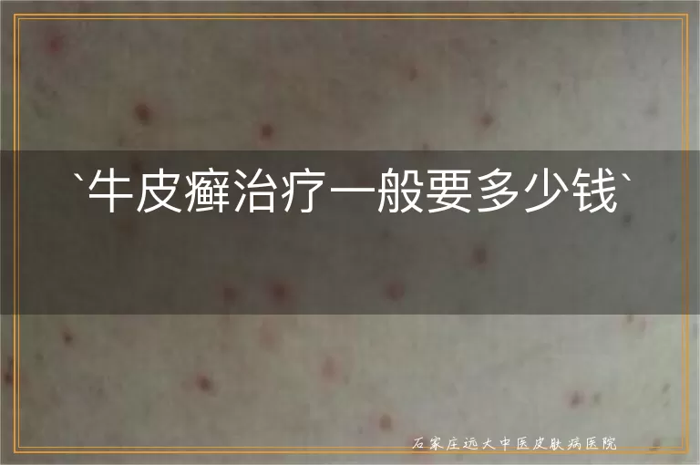 牛皮癣治疗一般要多少钱