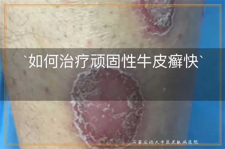 如何治疗顽固性牛皮癣快