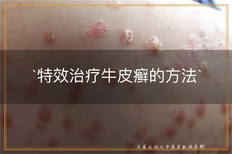 特效治疗牛皮癣的方法