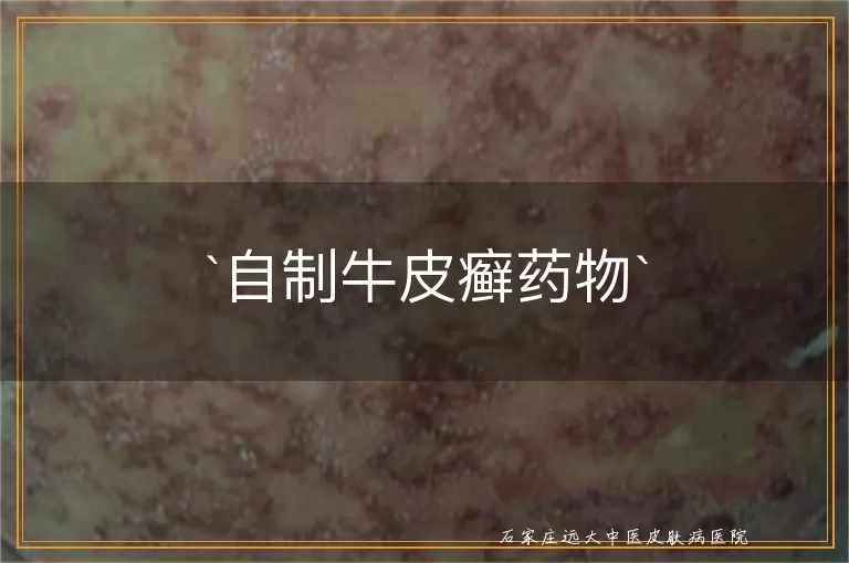 自制牛皮癣药物
