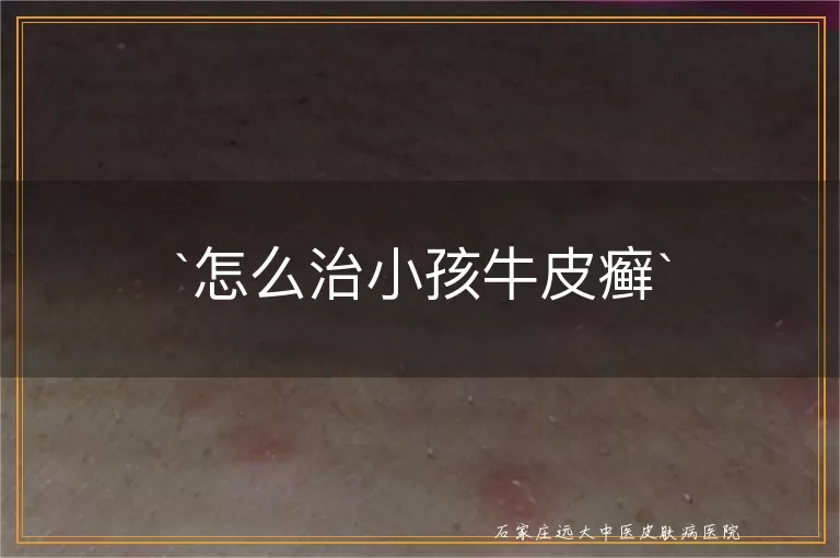怎么治小孩牛皮癣