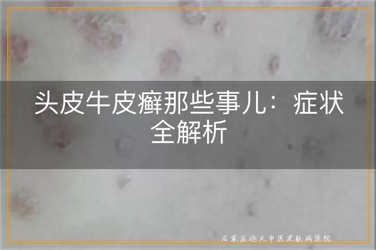 头皮牛皮癣那些事儿:症状全解析