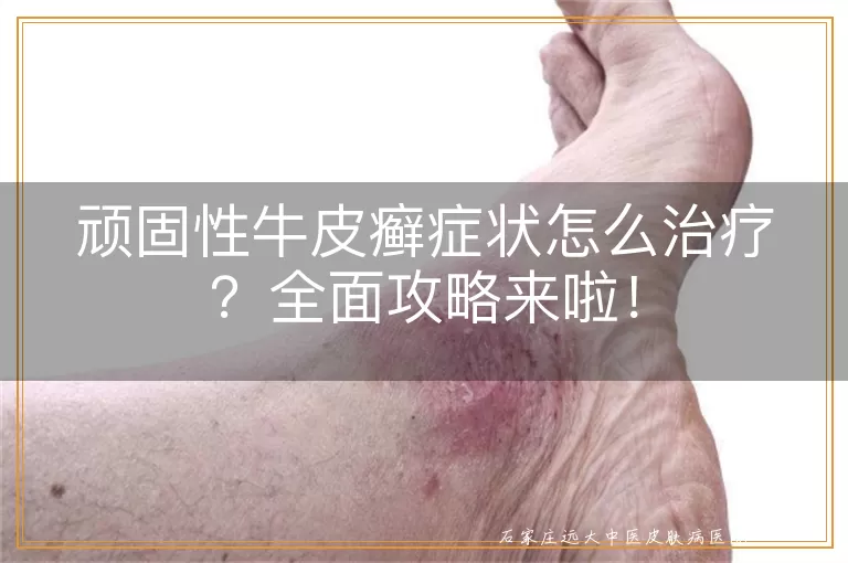顽固性牛皮癣症状怎么治疗?全面攻略来啦!