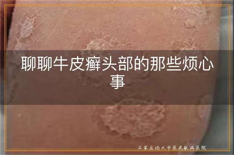 聊聊牛皮癣头部的那些烦心事