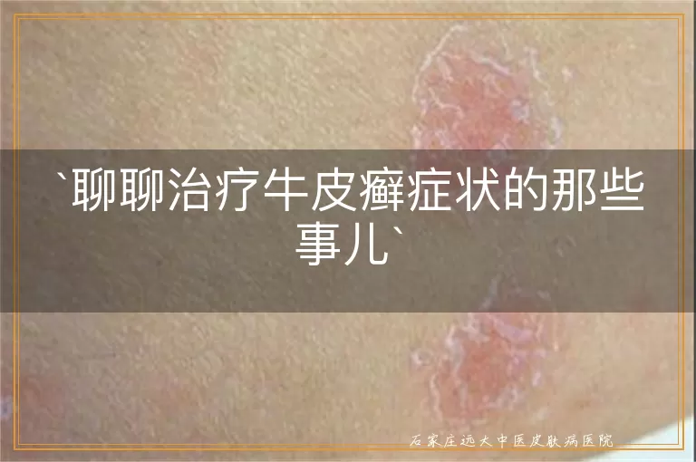 聊聊治疗牛皮癣症状的那些事儿