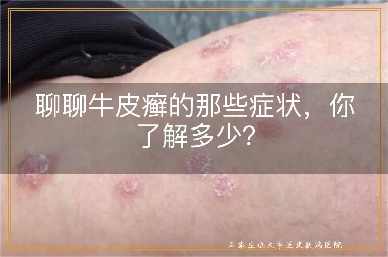 聊聊牛皮癣的那些症状,你了解多少?