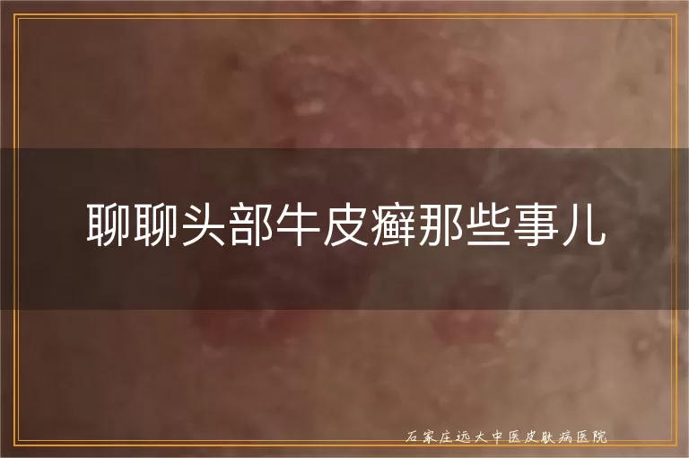 聊聊头部牛皮癣那些事儿