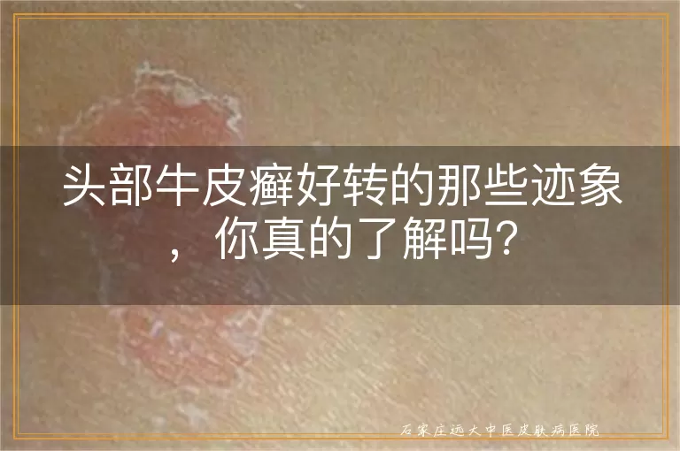 头部牛皮癣好转的那些迹象，你真的了解吗？