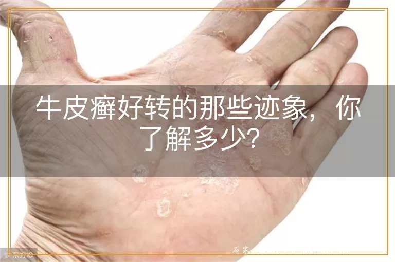 牛皮癣好转的那些迹象,你了解多少?