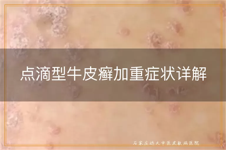点滴型牛皮癣加重症状详解