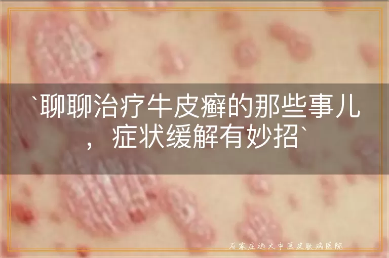 聊聊治疗牛皮癣的那些事儿,症状缓解有妙招