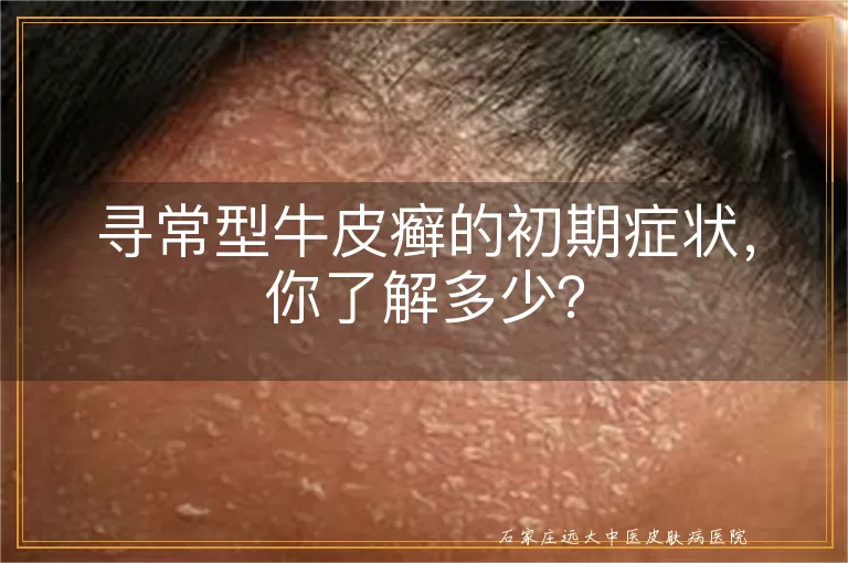 寻常型牛皮癣的初期症状，你了解多少？
