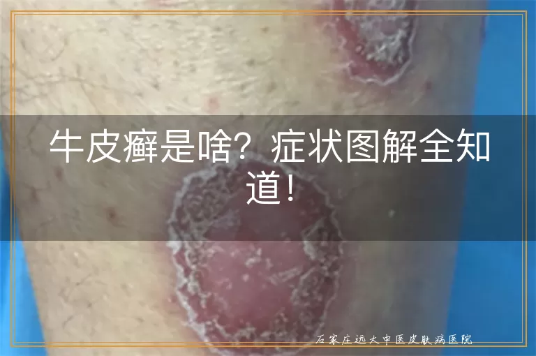 牛皮癣是啥？症状图解全知道！