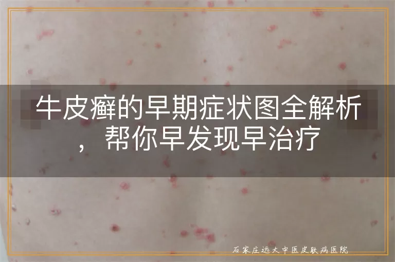 牛皮癣的早期症状图全解析，帮你早发现早治疗