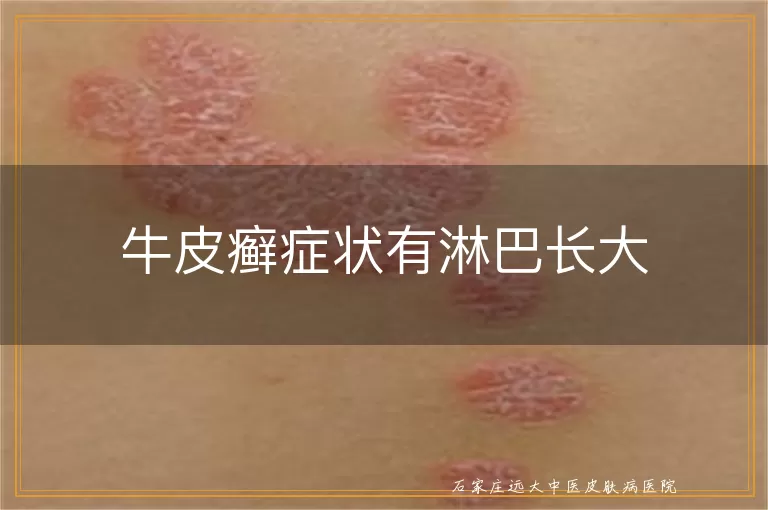 牛皮癣症状有淋巴长大