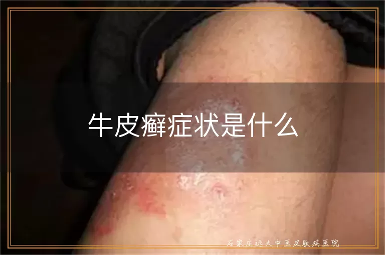 牛皮癣症状是什么