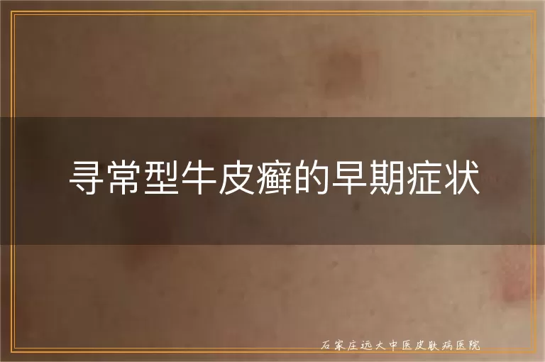 寻常型牛皮癣的早期症状