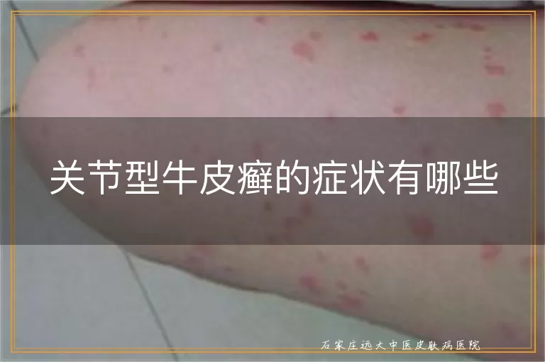 关节型牛皮癣的症状有哪些
