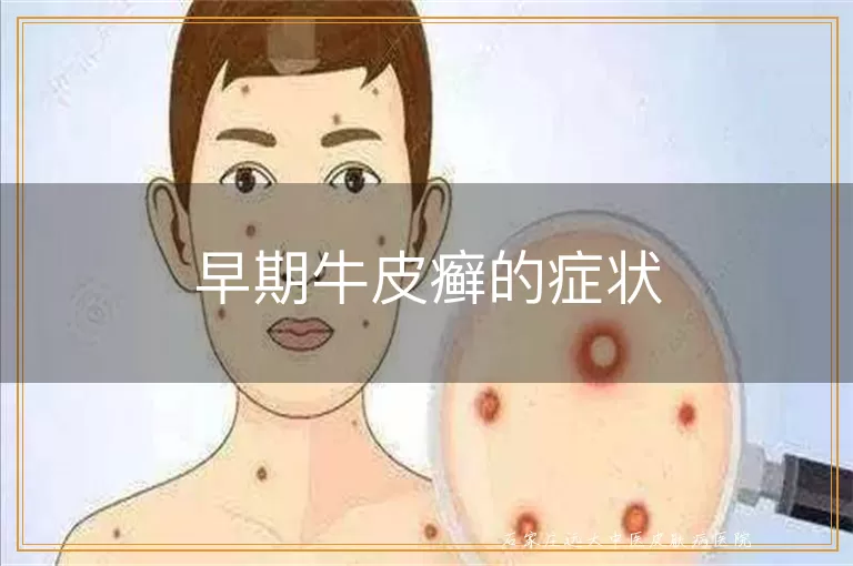 早期牛皮癣的症状