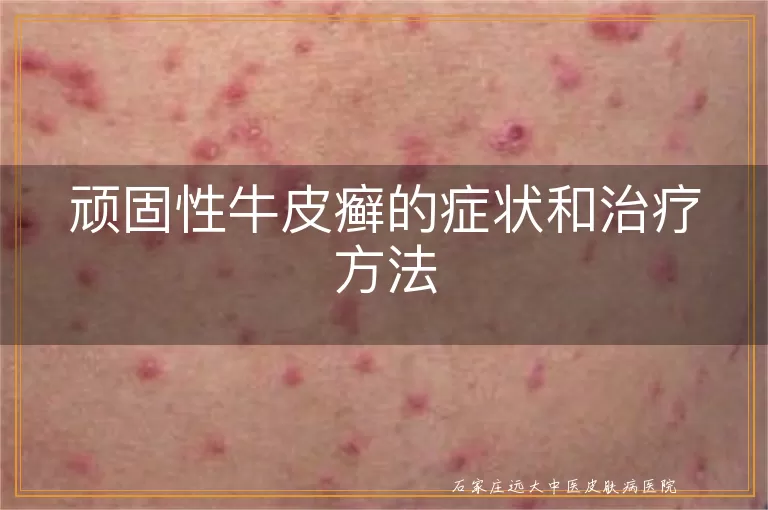 顽固性牛皮癣的症状和治疗方法