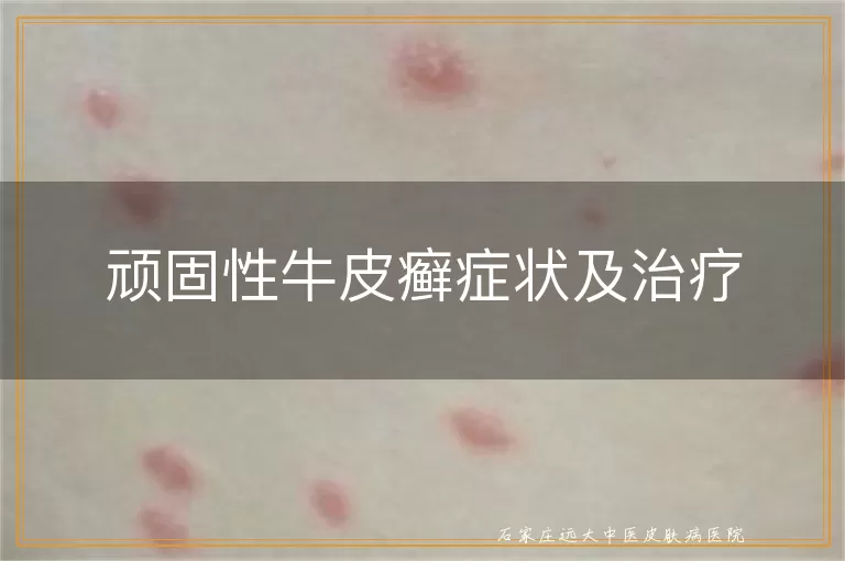 顽固性牛皮癣症状及治疗
