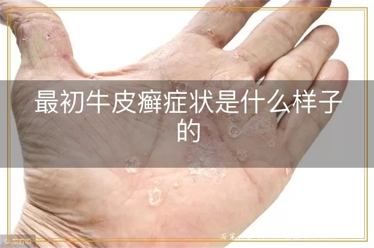 最初牛皮癣症状是什么样子的
