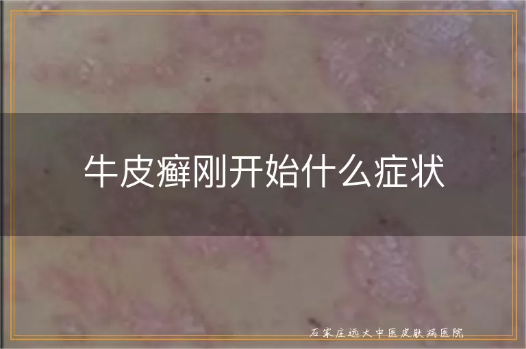 牛皮癣刚开始什么症状