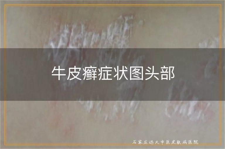 牛皮癣症状图头部