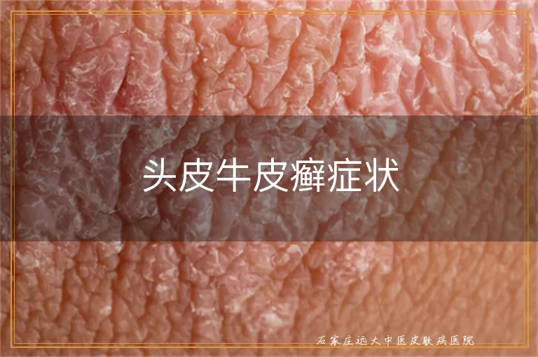 头皮牛皮癣症状