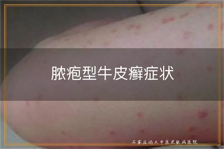 脓疱型牛皮癣症状