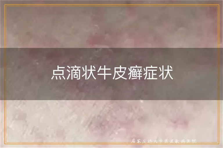 点滴状牛皮癣症状