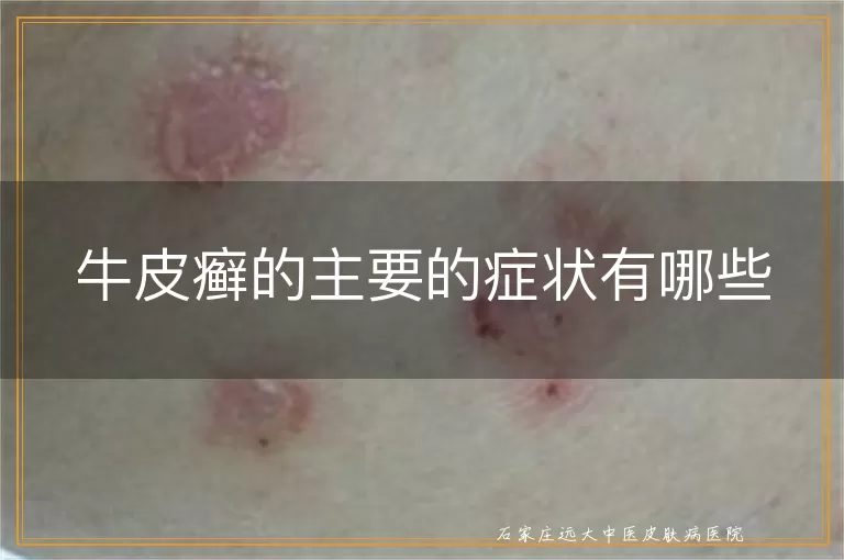 牛皮癣的主要的症状有哪些