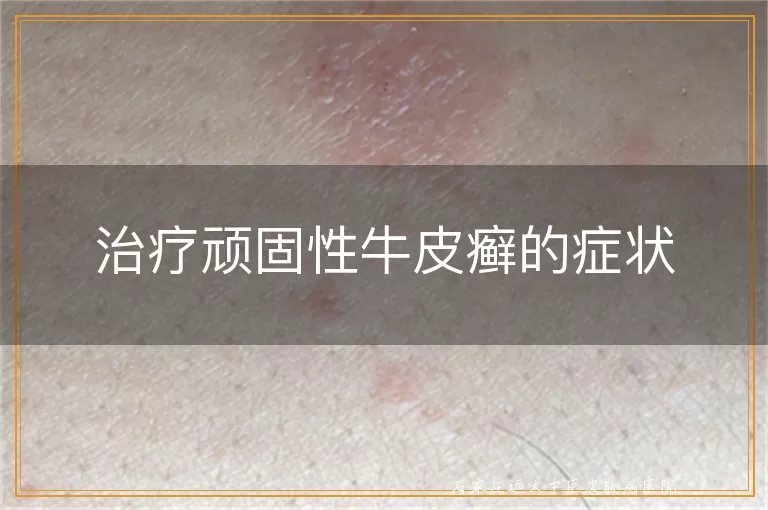 治疗顽固性牛皮癣的症状