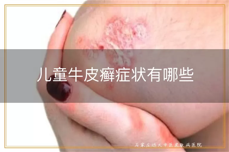 儿童牛皮癣症状有哪些