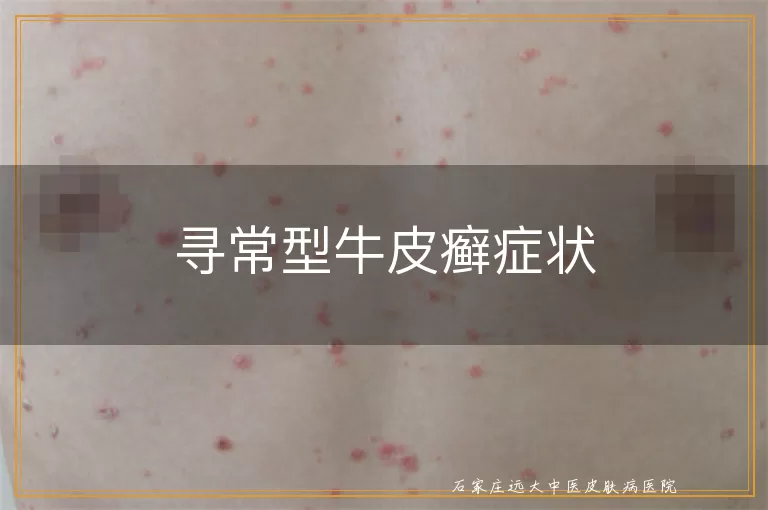 寻常型牛皮癣症状