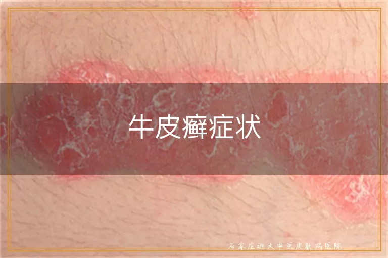 牛皮癣症状